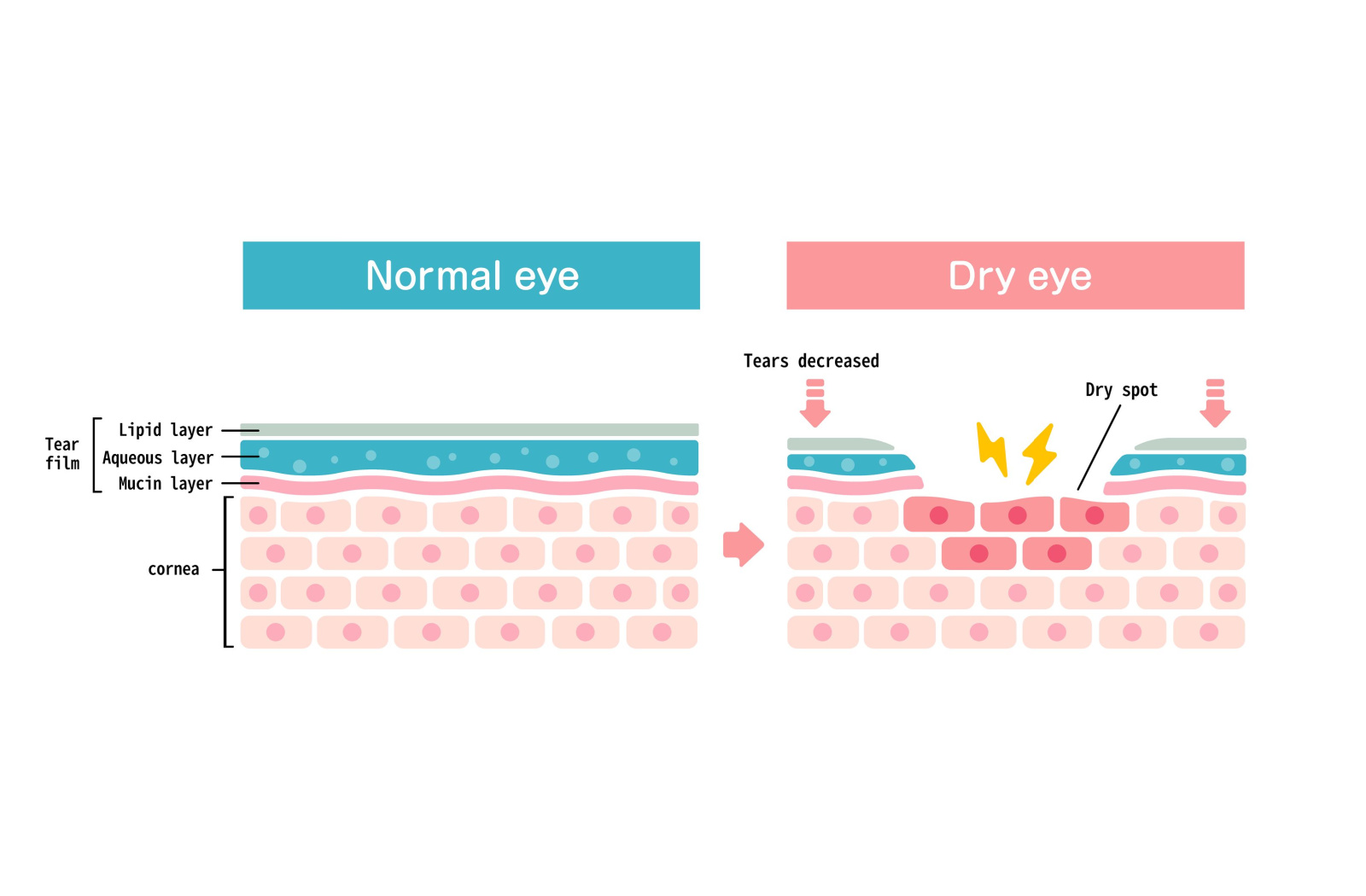 Graphical cross section comparison of the eye tissue of a normal eye versus that of one with dry eye.