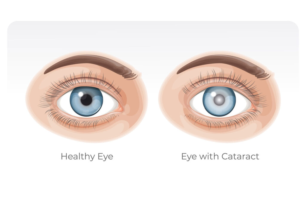 Graphical representation of a regular eye and the lens of an eye with a cataract.