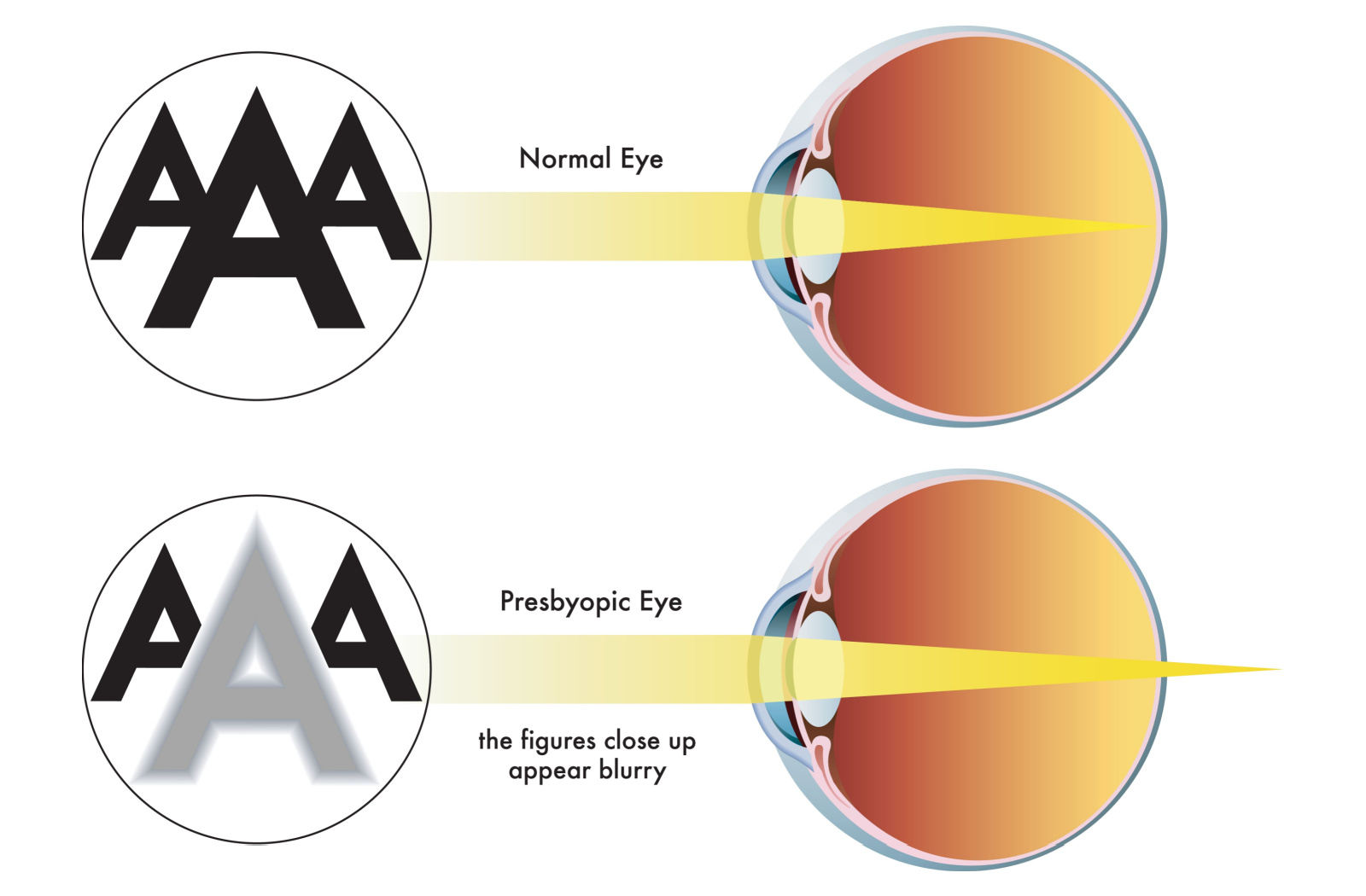 Drawing showing the difference between regular eye and presbyopic eye.