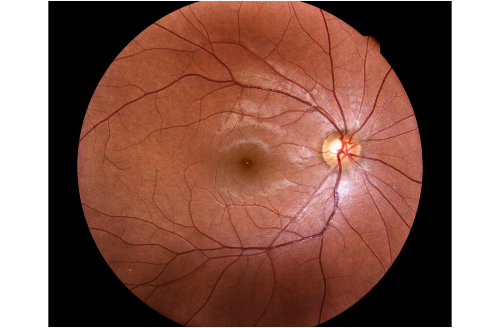 Diabetic retinopathy screening.