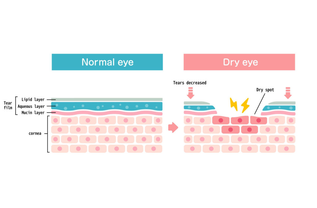 Graphic showing a cross section of normal retina and tear film, and that of a dry eye with a dry spot in the tear film.