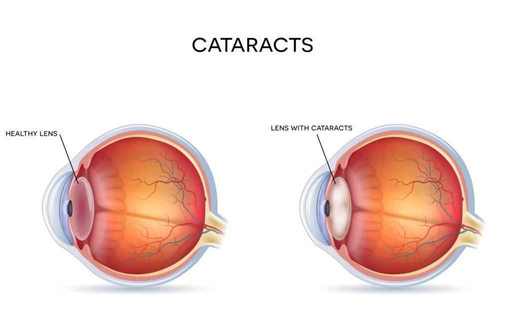 Cross section image of cataracts in an eye.