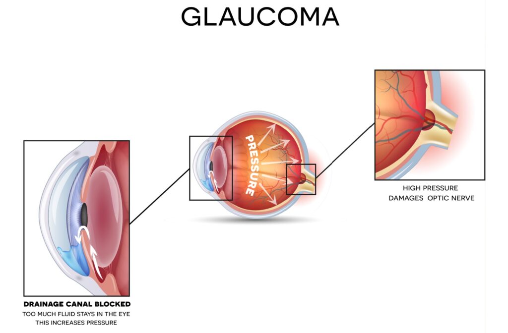 Glaucoma cross section diagram.