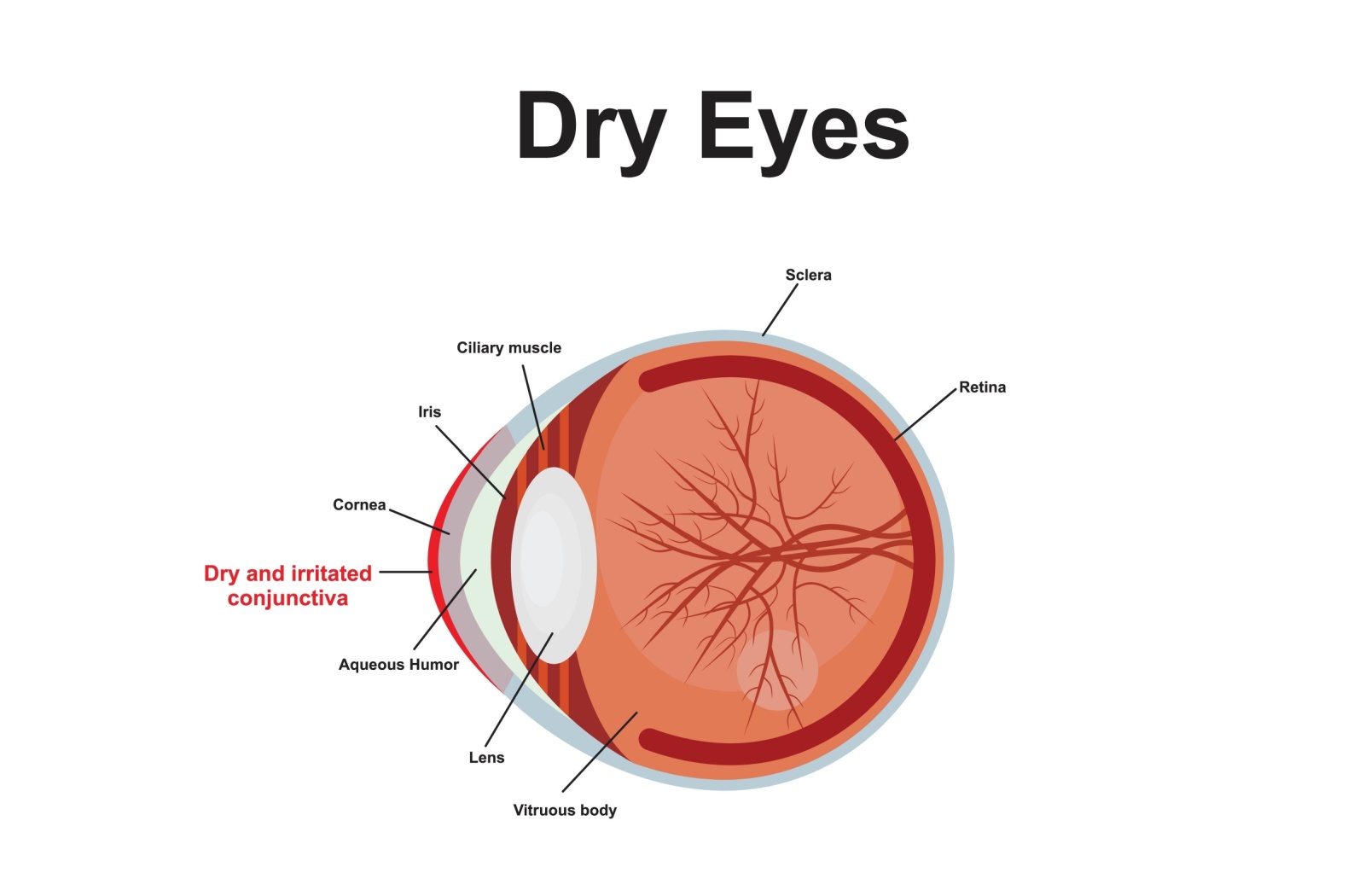 Diagram of an eye with labels showing structures such as the cornea, iris, lens, retina, and sclera, highlighting dry and irritated conjunctiva as a cause of dry eyes.