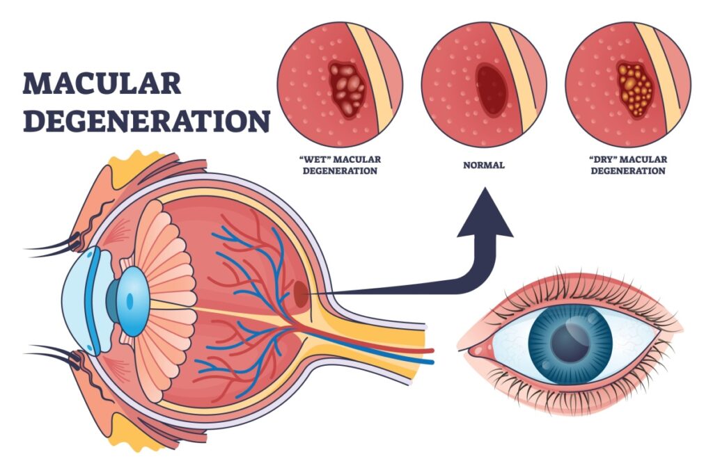 cross section illustration of an eye showing macular with zoomed in illustrations of normal vs wet and dry degeneration.