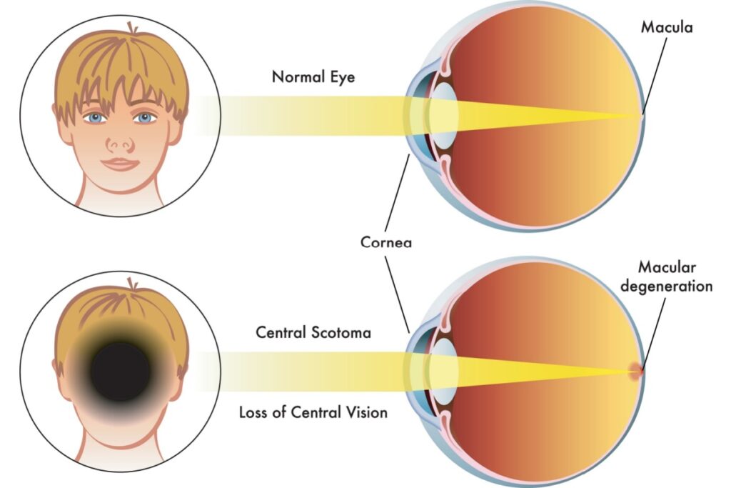 illustration showing vision with normal eye and loss of central vision with macular degeneration.