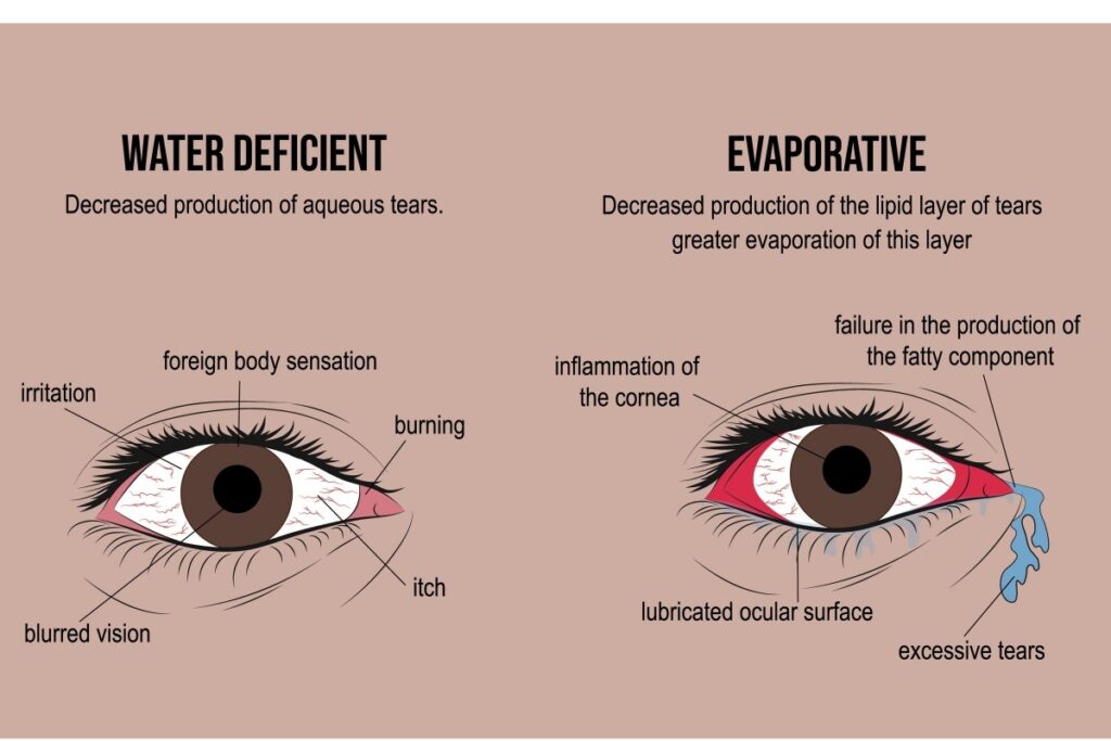 Medical illustration comparing water deficient and evaporative dry eye types, showing two eyes with labeled symptoms including irritation, burning, blurred vision, inflammation, foreign body sensation, and excessive tearing, demonstrating decreased aqueous tear production versus decreased lipid layer production.