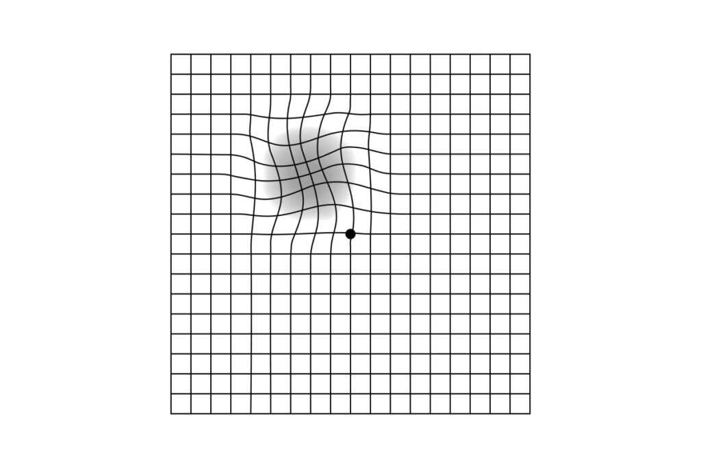 Amsler grid with wavy section illustration.