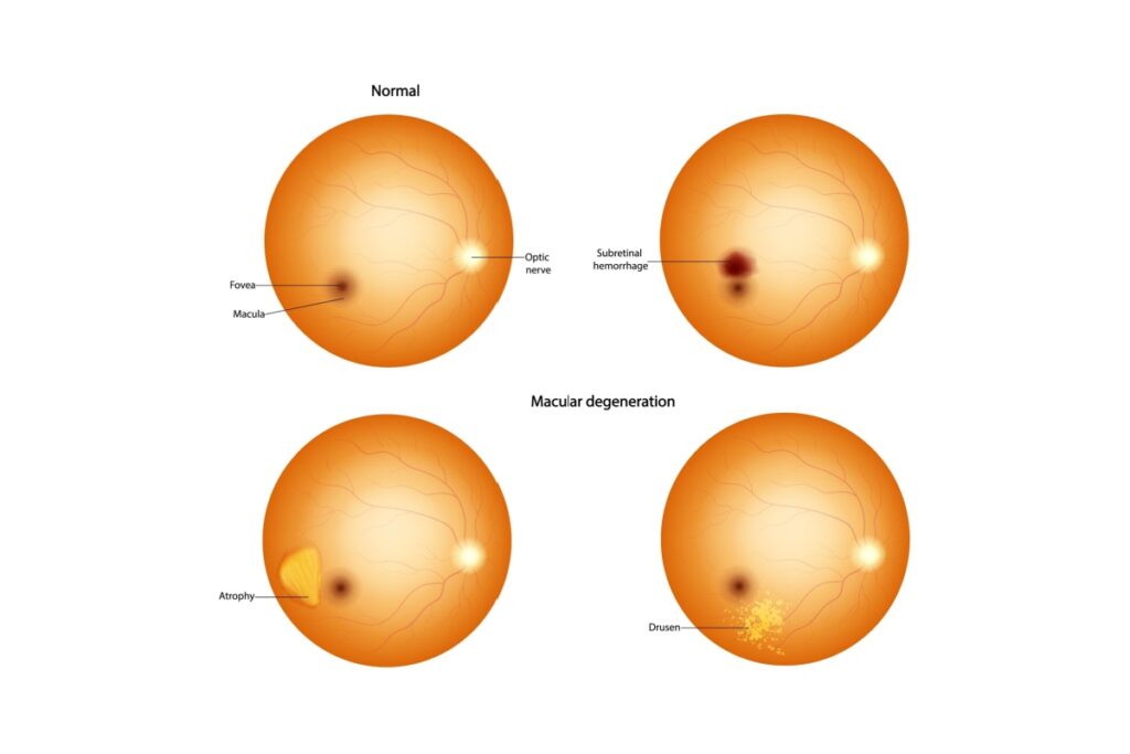Illustration of normal eye vs amd.